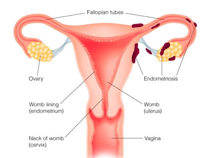 endometriosis-nutritional-therapy